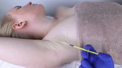 Armpit injection botulinum toxin. Cream marking for injection sites. Pain relief Stock Footage 169988624