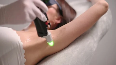 Armpit laser depilation. Stock Footage 167030151