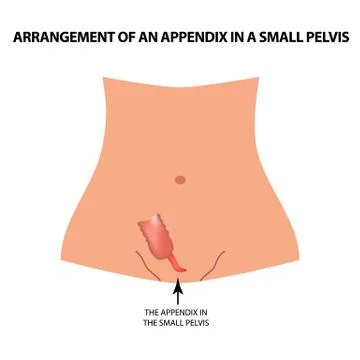 Arrangement of an appendix in a small pelvis. The appendix in the small pelvis Illustrazione stock