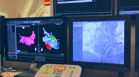 Arrhythmia surgery Video stock 49103605