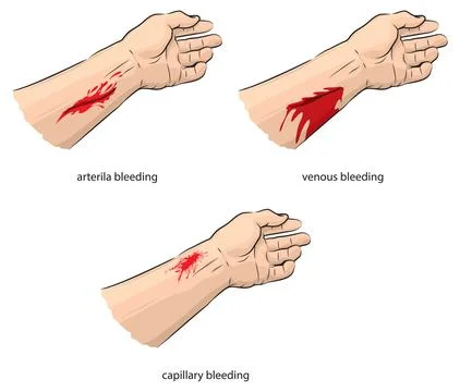 Arterial and venous bleeding Stock Illustration