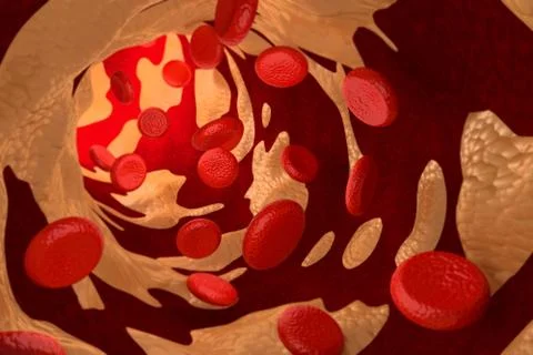 Arteriosclerosis by Cholesterol Plaque, 3D Rendering Stock Illustration