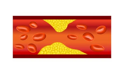 Arteriosclerosis concept Stock Illustration