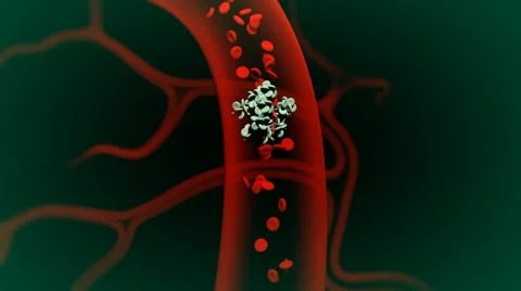Artery blockage - embolus (clot) Stockbeeldmateriaal 50421540