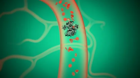 Artery blockage - embolus (clot) version 2 Stock Footage 50421431