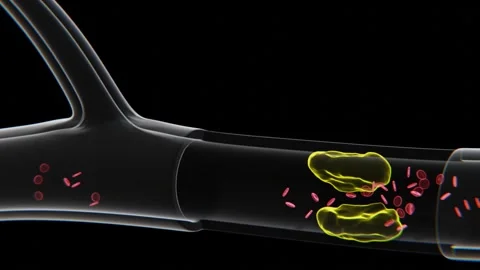 Artery Blockage visualization video in 4K | Xray video of Artery Blockage Stock Footage 331605706