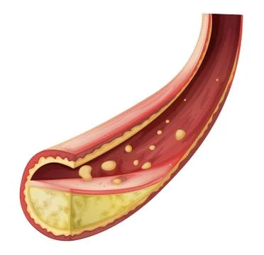 Artery blocked with cholesterol Stock Illustration