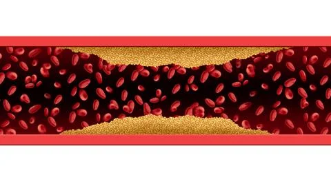Artery Cholesterol Risk Stock Illustration