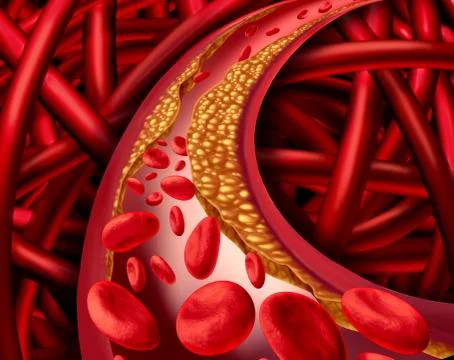 Artery Disease Illustrazione stock