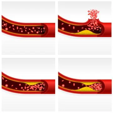Artery section with cholesterol and thrombosis, cerebral stroke and heart att Stock Illustration
