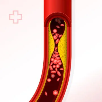 Artery section with cholesterol buildup - cholesterol and thrombosis Stock Illustration