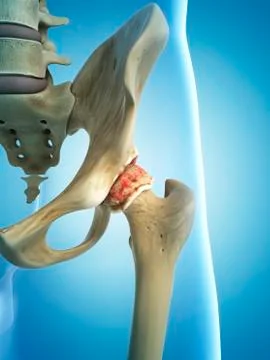 Arthritic hip, artwork Stock Illustration
