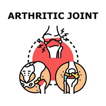 Arthritic joint disease causing pain and inflammation Illustrazione stock
