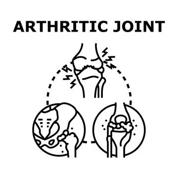 Arthritic joint disease causing pain and inflammation Illustrazione stock