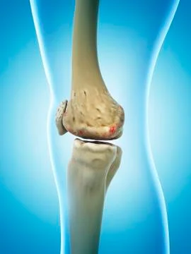 Arthritic knee, artwork Illustrazione stock