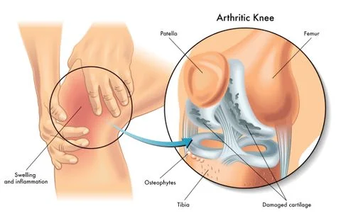 Arthritic knee Stock Illustration