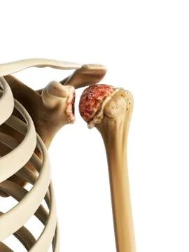 Arthritic shoulder, artwork Stock Illustration