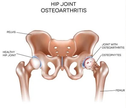 Arthritis of the hip joint Illustrazione stock