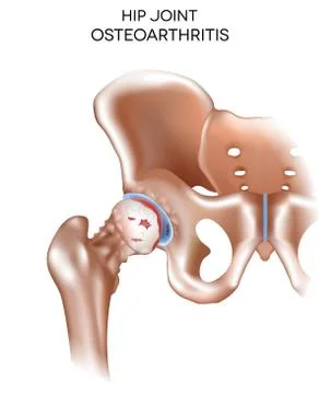 Arthritis of the hip joint Stock Illustration