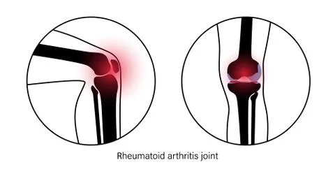 Arthritis in knee joint Stock Illustration