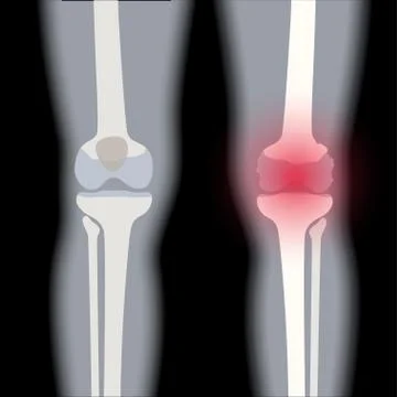 Arthritis in knee joint Illustrazione stock