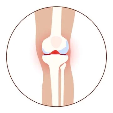 Arthritis in knee joint Stock Illustration