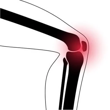 Arthritis in knee joint Stock Illustration