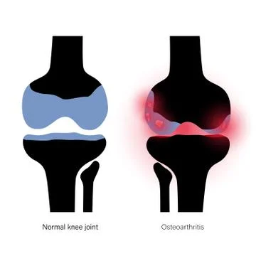 Arthritis in knee joint Stock Illustration
