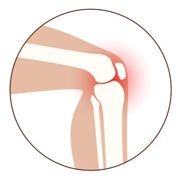 Arthritis in knee joint Stock Illustration