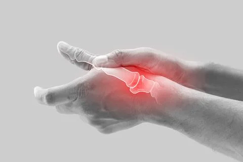 Arthritis. Stock Photos