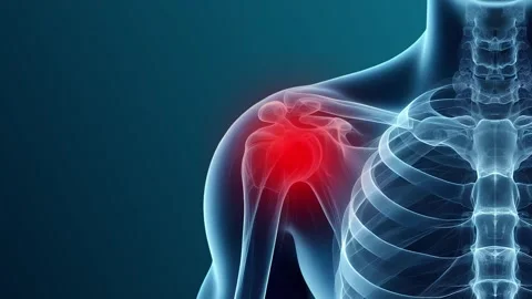 Arthritis in Shoulders Animated Visualization Stock Footage 317143496