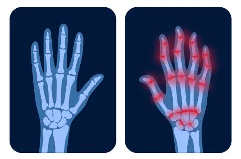 Arthrits x ray Stock Illustration