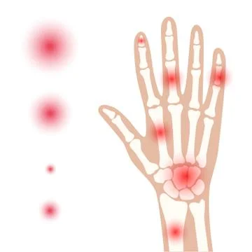 Arthrits x ray Stock Illustration