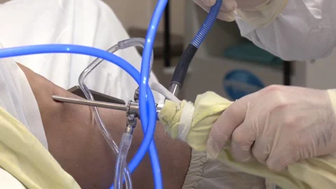 Arthroscope surgery. Knee surgery 스톡 동영상 314962851