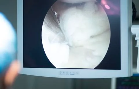 Arthroscopy surgery screen Stock Photos