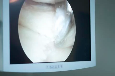 Arthroscopy surgery screen Stock Photos
