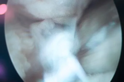 Arthroscopy surgery screen Stock Photos