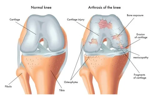 Arthrosis of the knee Stock Illustration