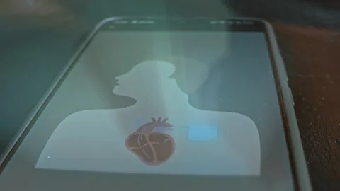 Artificial Cardiac Pacemaker illustration, presentation on smartphone Stock Footage 304523581