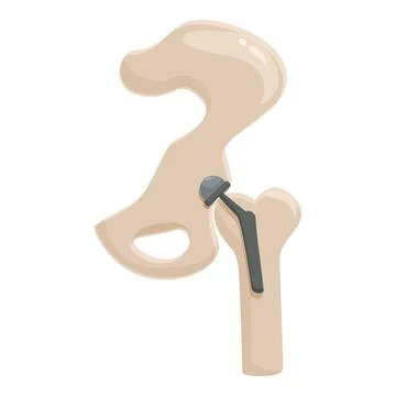 Artificial hip joint replacement illustration Stock Illustration