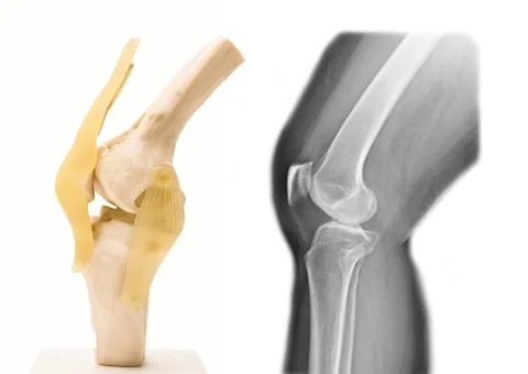 Artificial human knee joint model in medical Stock Photos