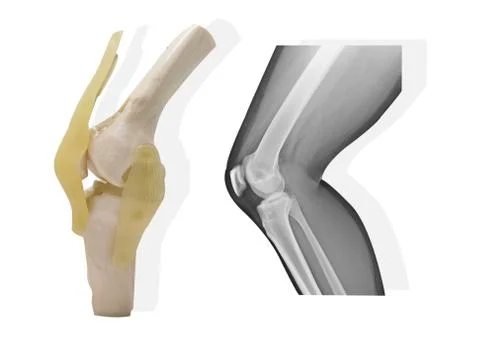Artificial human knee joint model with Medical x-ray knee normal joint on whi Stock Photos