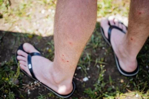 Artificial human legs from insect bites, red dots of midge bite, legs dressed Stock Photos