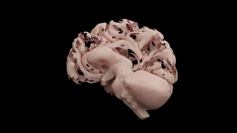 Artificial Intelligence Brain Cognitive Decline Alzheimer's Dementia Disease Stock Footage 247893251