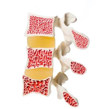 Artificial model of osteoporosis Stock Photos