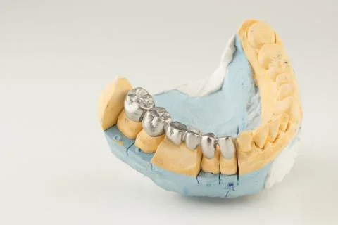 Artificial tooth crown Stock Photos