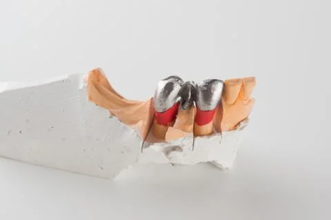 Artificial tooth crown Stock Photos