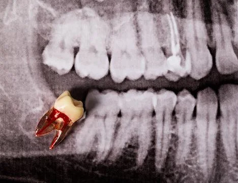 Artificial wisdom tooth against the background of an extracted wisdom tooth in Foto stock