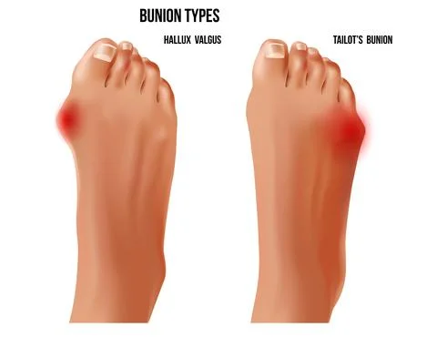Artritic bunion types rheumatoid sore joints with red pain points top view. R Stock Illustration