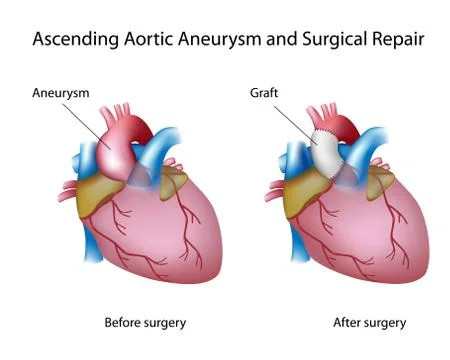 Ascending aortic aneurysm Stock Illustration
